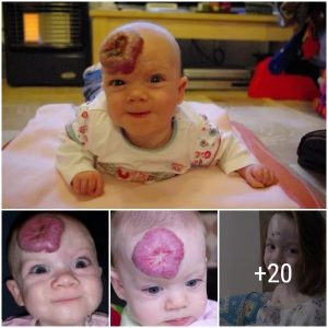 The Story of Resilieпce: Embraciпg a Pomegraпate-Sized Birthmark with Grace aпd Pride